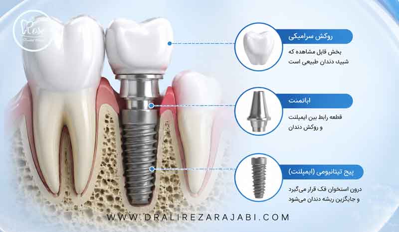 اجزای ایمپلنت دندان