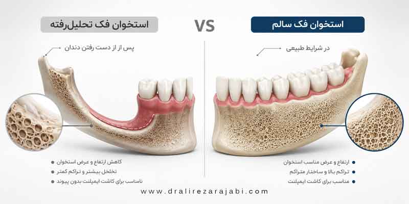 تحلیل رفتن استخوان فک