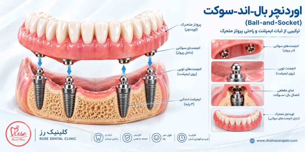 • اوردنچر بال-اند-سوکت (Ball Attachment):