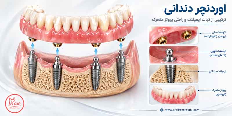 اوردنچر چیست ؟
