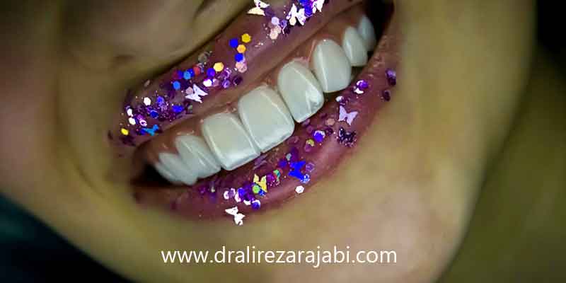 کامپوزیت ونیر کلینیک دندان پزشکی رز